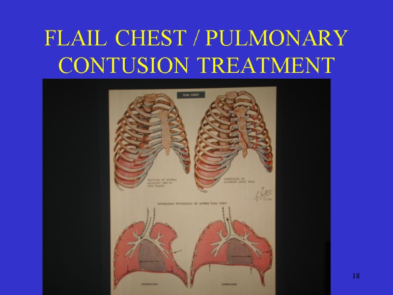 18 FLAIL CHEST / PULMONARY CONTUSION TREATMENT